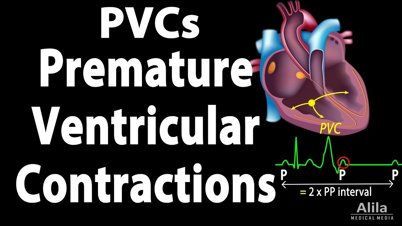 آریتمی قلبی PVC چیست؟