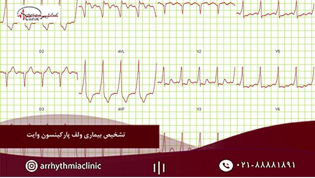 تشخیص بیماری ولف پارکینسون وایت