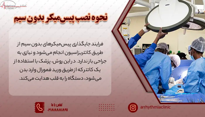 نحوه نصب پیس‌میکرهای بدون سیم 