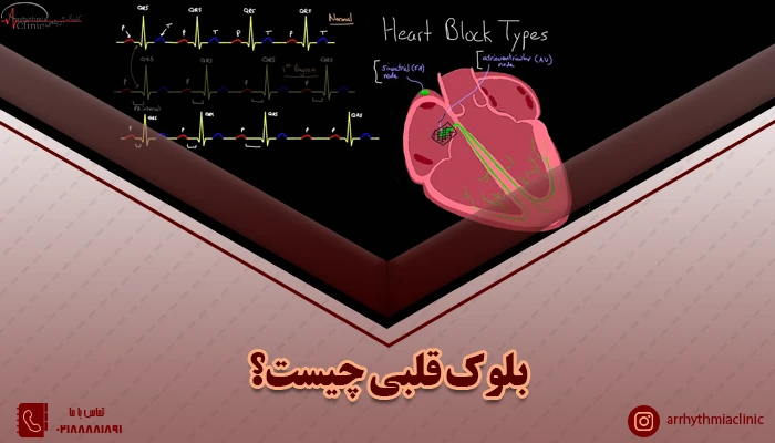 آشنایی با بلوک قلبی Heart Block و راه های درمان آن برای بیماران قلبی