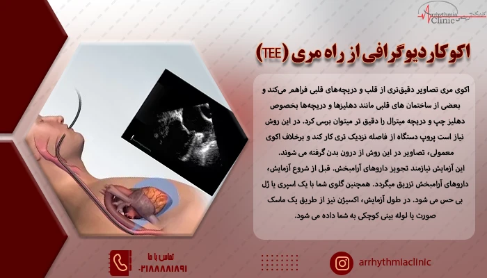 روش انجام اکوکاردیوگرافی از راه مری (TEE) در کلینیک آریتمی توانیر تهران