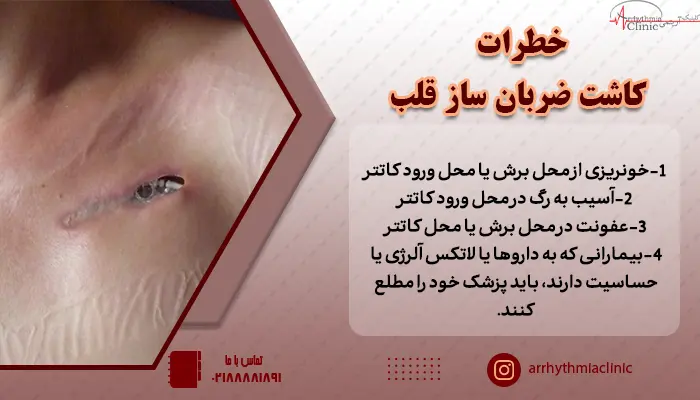 خطرات و عوارض کاشت ضربان ساز قلب