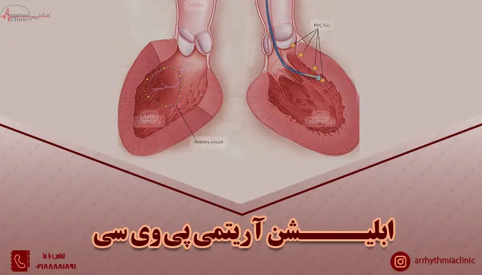 ابلیشن آریتمی پی وی سی