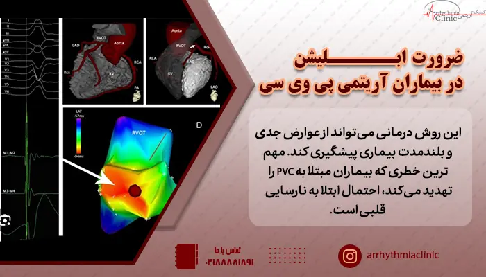 ضرورت ابلیشن در بیماران آریتمی پی وی سی