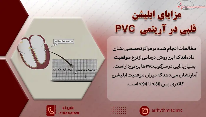 مزایای ابلیشن قلبی در آریتمی Pvc