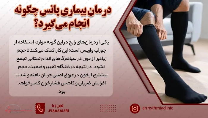 یکی از درمان‌های رایج پاتس، استفاده از جوراب واریس است.