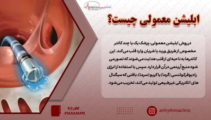 در روش ابلیشن معمولی، پزشک یک یا چند کاتتر مخصوص از طریق ورید یا شریان وارد قلب می‌کند.