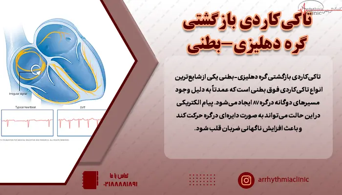 در تاکی‌کاردی بازگشتی گره دهلیزی-بطنی پیام الکتریکی در دو مسیر با سرعت بالا حرکن کرده و ضربان قلب را افزایش می‌دهد.