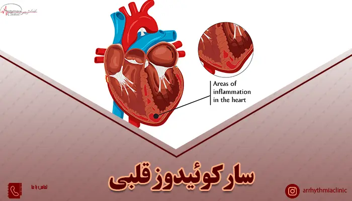 سارکوئیدوز قلبی